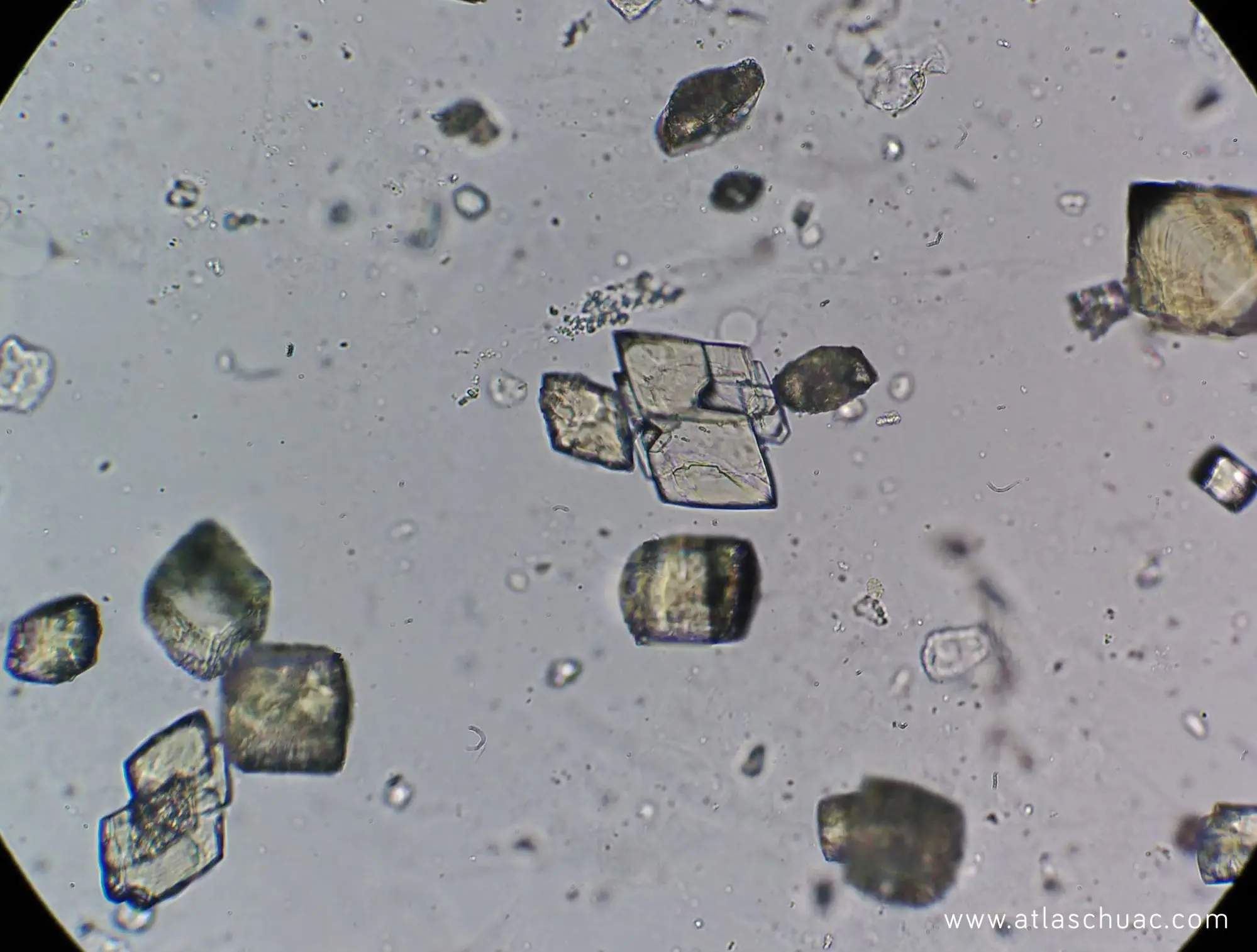 Los cristales de ácido úrico dihidratado: causas, síntomas y tratamiento - Cómo disolver los cristales de ácido úrico cristales de acido urico dihidratado - Cómo disolver los cristales de ácido úrico