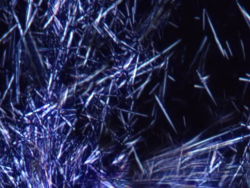 cristales birrefringentes negativos - Cómo interpretar el líquido sinovial
