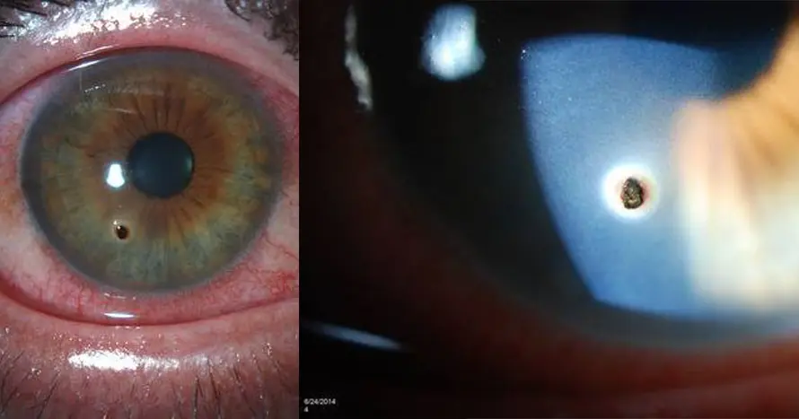 Cómo sacar un vidrio del ojo de forma segura - Cómo saber si tengo un pedazo de vidrio en el ojo como sacar un vidrio del ojo - Cómo saber si tengo un pedazo de vidrio en el ojo