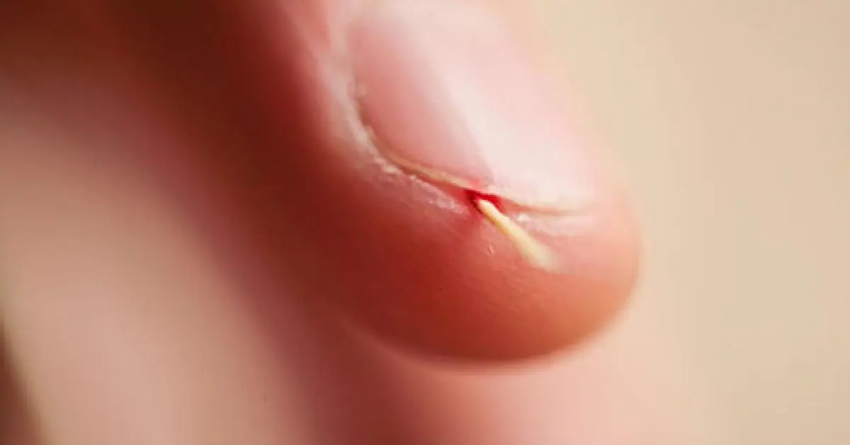 Vidrio dentro de la piel: riesgos, síntomas y tratamiento - Cómo saber si tengo un vidrio en la piel vidrio dentro de la piel - Cómo saber si tengo un vidrio en la piel
