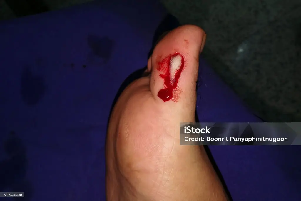 Qué hacer ante una cortadura de vidrio - Cómo se cura un corte en el dedo me corte el dedo con un vidrio - Cómo se cura un corte en el dedo