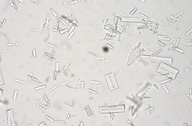 Cristales de glucosa en orina: ¿Qué son y qué significan? - Cómo se elimina la glucosa en la orina cristales de glucosa en orina - Cómo se elimina la glucosa en la orina