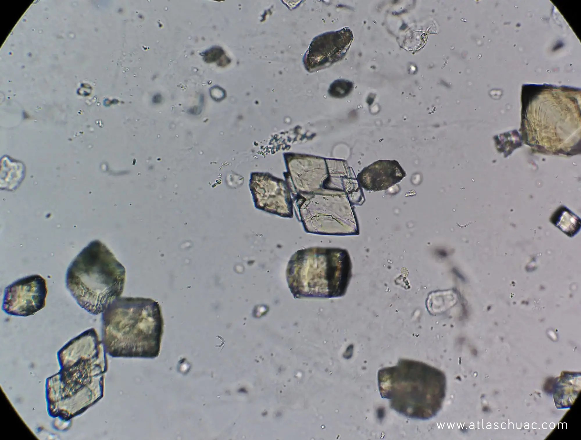 cristales de acido urico en sedimento urinario - Cómo se forman los cristales de ácido úrico