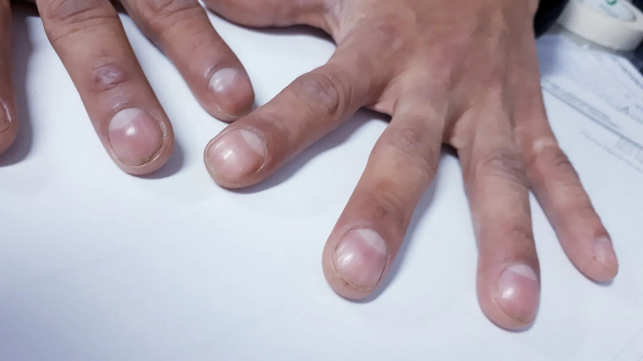 Uñas en vidrio de reloj: ¿Qué son y qué nos indican? - Cómo se llama el vidrio de reloj uñas en vidrio de reloj - Cómo se llama el vidrio de reloj