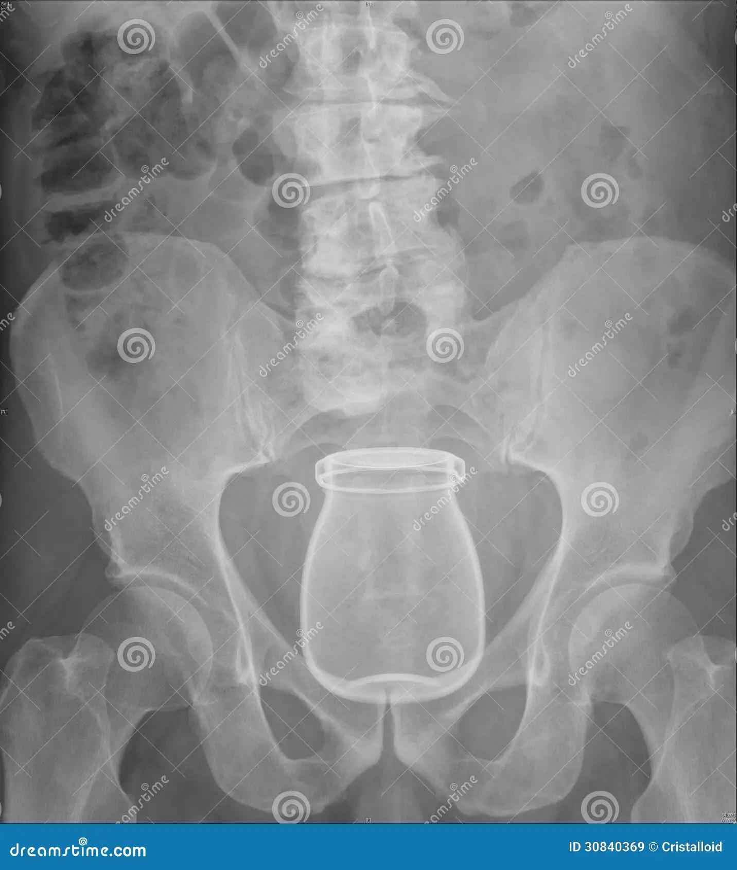 Vidrio en RX: una herramienta esencial en odontología - Cómo se ve el vidrio en una Rx vidrio en rx - Cómo se ve el vidrio en una Rx