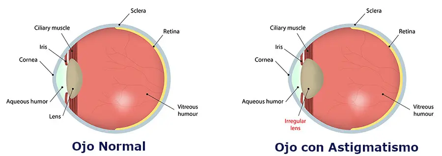 Cristales para el astigmatismo: mejora tu visión - Cómo se ve la luz cuando tienes astigmatismo cristales astigmatismo - Cómo se ve la luz cuando tienes astigmatismo