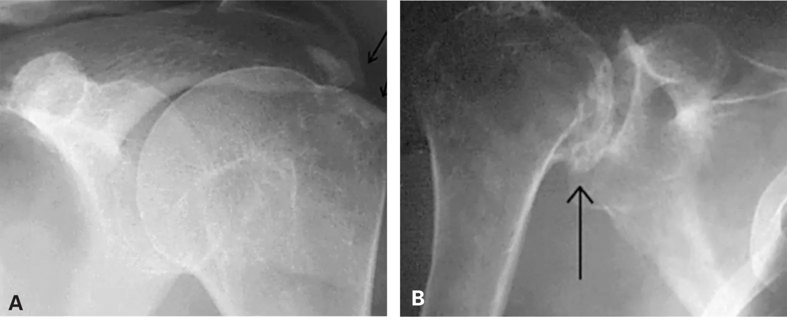 Cristales de pirofosfato cálcico: ¿Qué son y cómo afectan a las articulaciones? - Cuál de las siguientes articulaciones se afecta con mayor frecuencia en la enfermedad por depósito de cristales de pirofosfato de calcio cristales de pirofosfato cálcico - Cuál de las siguientes articulaciones se afecta con mayor frecuencia en la enfermedad por depósito de cristales de pirofosfato de calcio