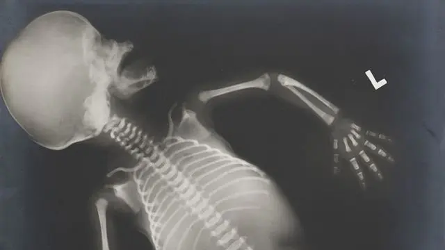 Huesos de Cristal: Una Enfermedad Rara pero Devastadora - Cuántos años puede vivir una persona con osteogénesis imperfecta huesos de cristal - Cuántos años puede vivir una persona con osteogénesis imperfecta