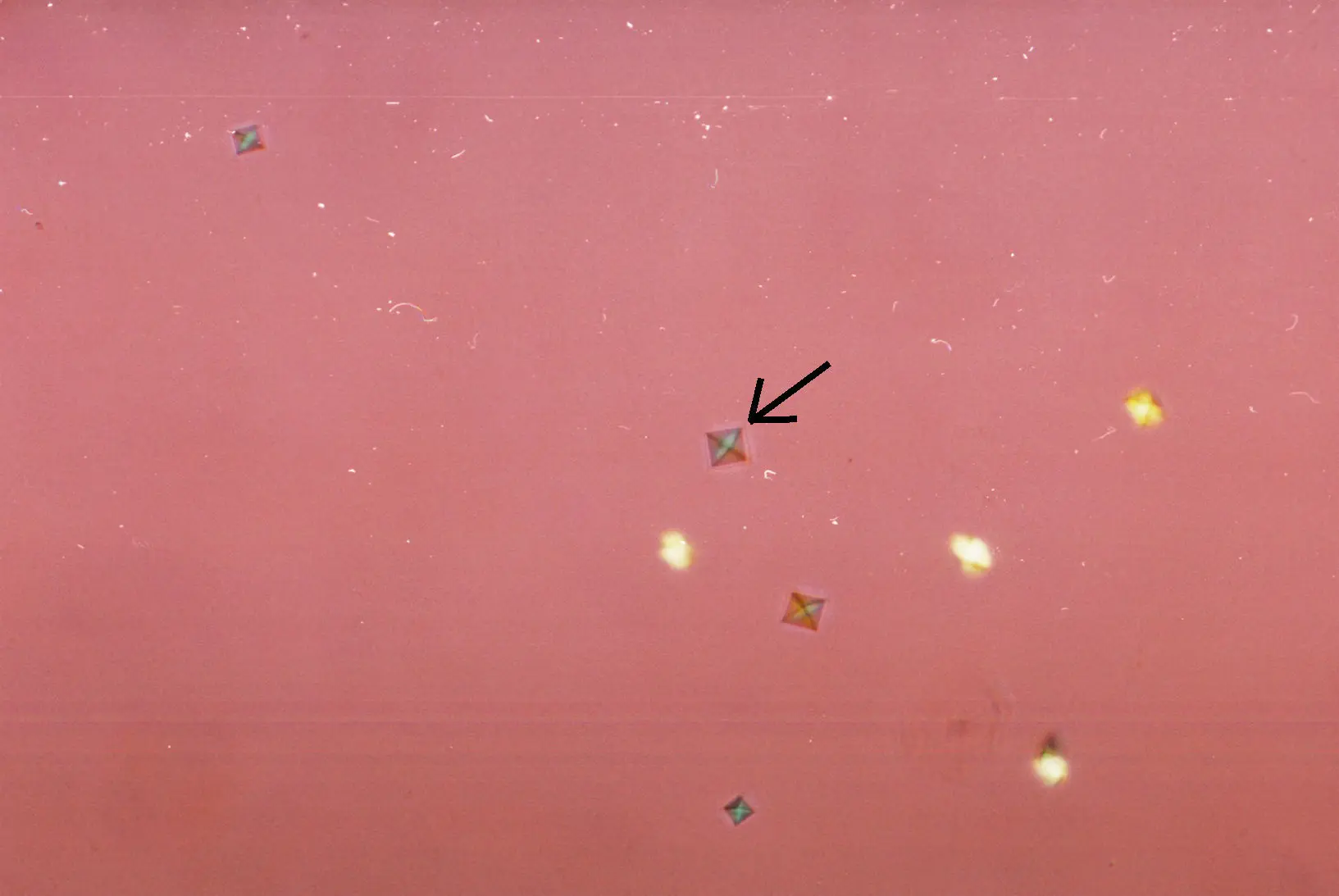 cristales birrefringentes negativos - Qué enfermedades se pueden diagnosticar con el líquido sinovial