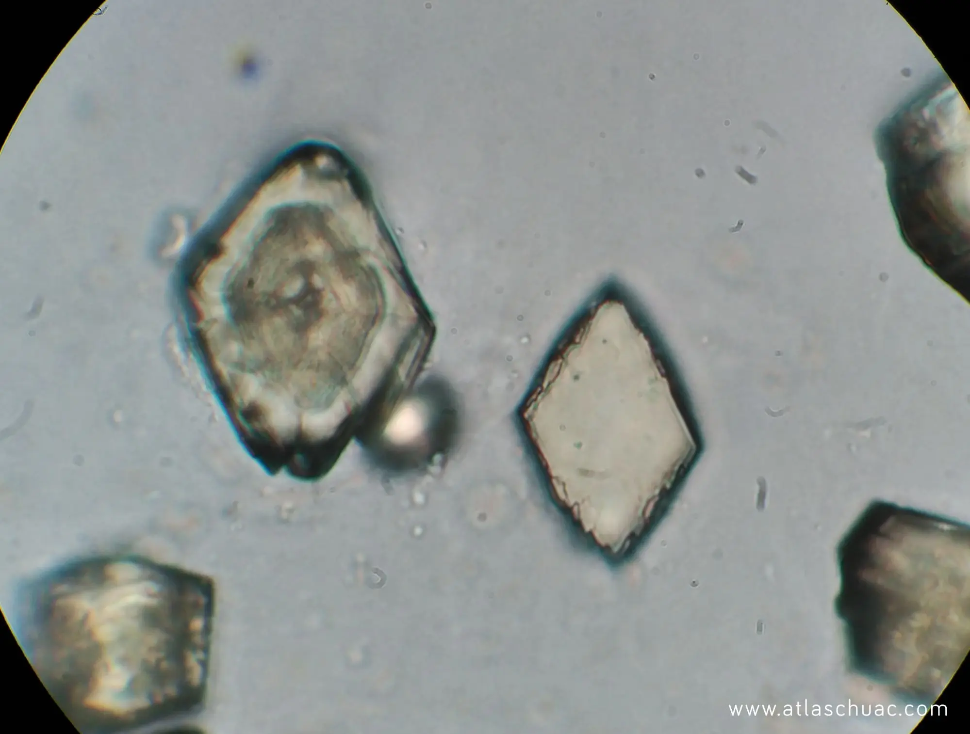 Los cristales de ácido úrico dihidratado: causas, síntomas y tratamiento - Qué es el ácido úrico en suero cristales de acido urico dihidratado - Qué es el ácido úrico en suero