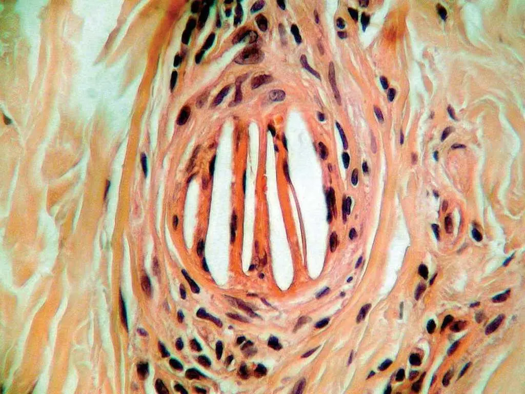 Cristales de Colesterol en Histología: Una Complicación de la Enfermedad Arterioesclerótica - Qué es la Ateroembolia cristales de colesterol histologia - Qué es la Ateroembolia
