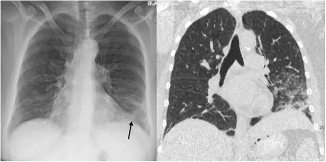 Opacidad en vidrio esmerilado pulmonar: ¿Qué es y cómo se diagnostica? - Qué es la consolidación pulmonar opacidad en vidrio esmerilado pulmon - Qué es la consolidación pulmonar