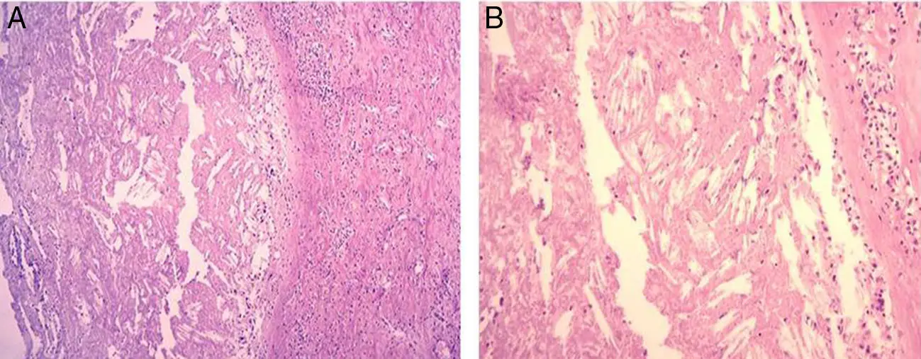 Cristales de Colesterol en Histología: Una Complicación de la Enfermedad Arterioesclerótica - Qué es la embolia ateromatosa cristales de colesterol histologia - Qué es la embolia ateromatosa