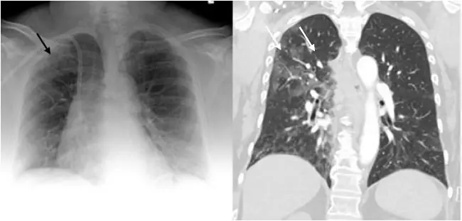 radiografia de torax en vidrio esmerilado - Qué es la enfermedad de fibrosis pulmonar