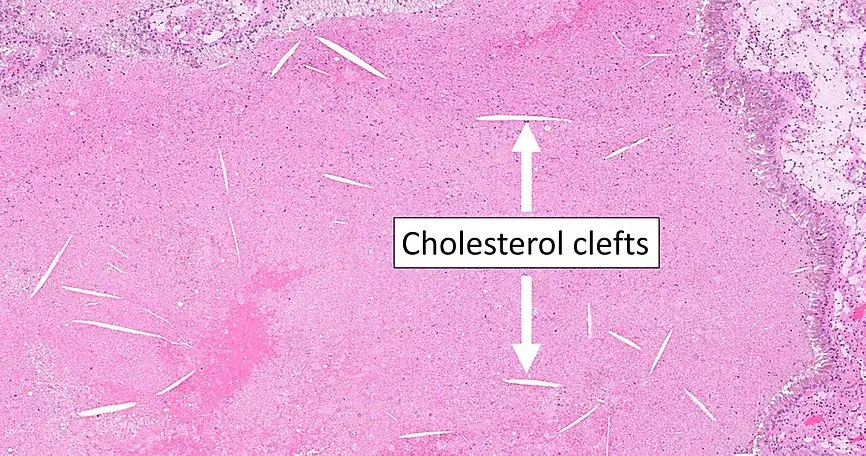 Cristales de Colesterol en Histología: Una Complicación de la Enfermedad Arterioesclerótica - Qué forma tiene el cristal de colesterol cristales de colesterol histologia - Qué forma tiene el cristal de colesterol