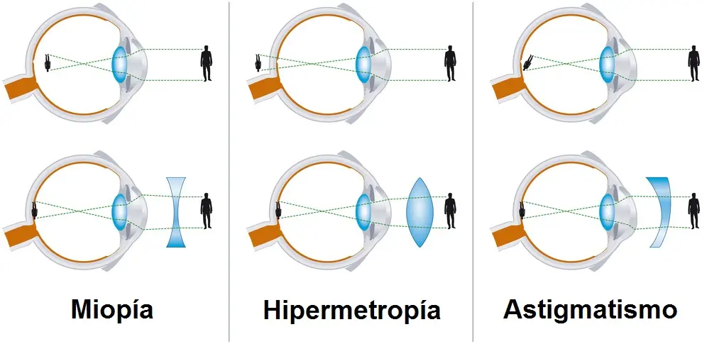 Cristales para el astigmatismo: mejora tu visión - Qué lente corrige la astigmatismo cristales astigmatismo - Qué lente corrige la astigmatismo