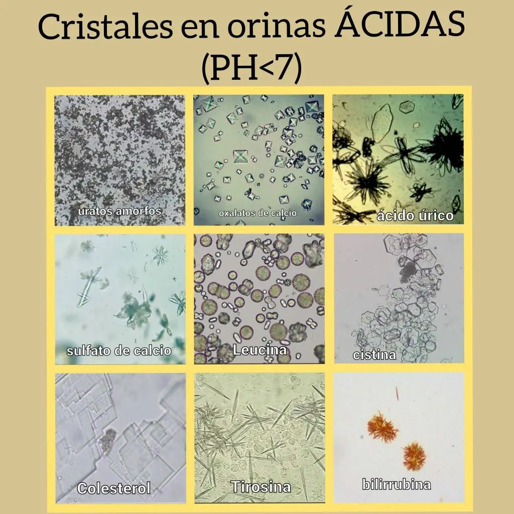 Cristales en orina pH ácido: causas, síntomas y tratamiento - Qué papel juega el pH urinario en la aparición de cristales en la orina cristales en orina ph acido - Qué papel juega el pH urinario en la aparición de cristales en la orina