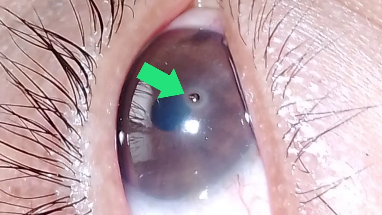 Cómo sacar un vidrio del ojo de forma segura - Qué pasa si no puedo sacar basura del ojo como sacar un vidrio del ojo - Qué pasa si no puedo sacar basura del ojo