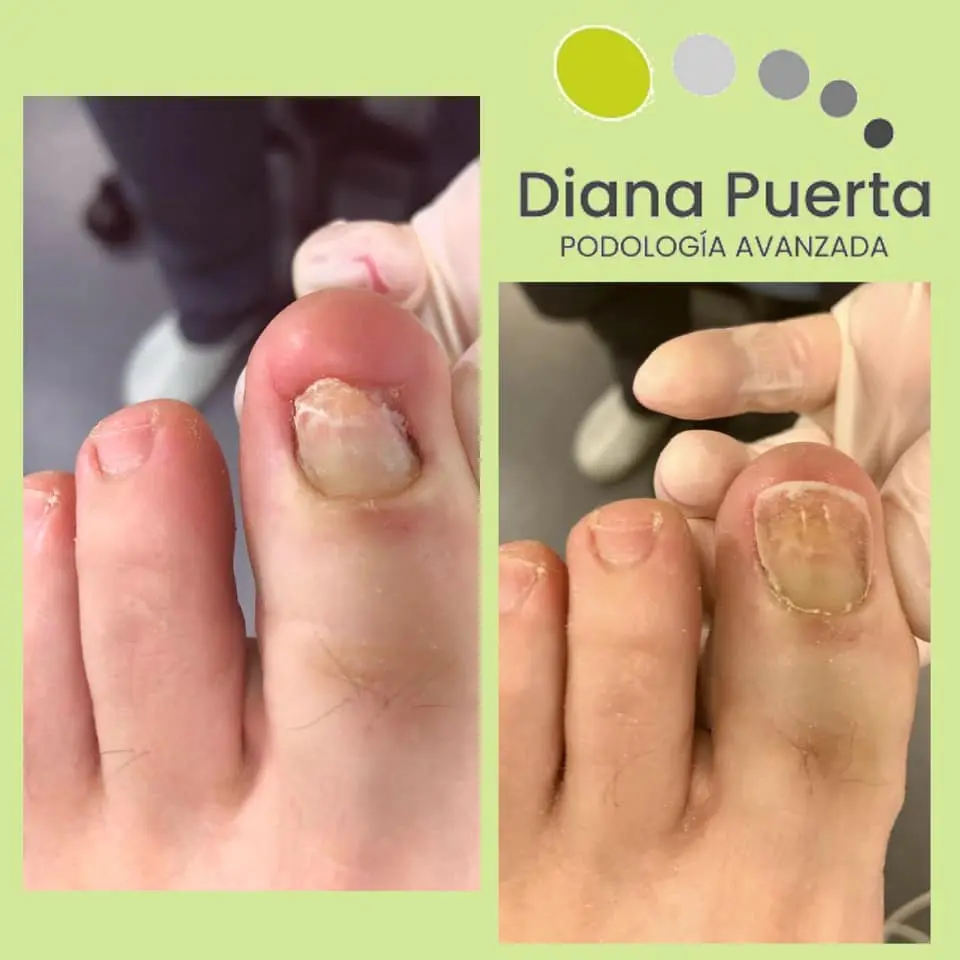 Uñas en vidrio de reloj: ¿Qué son y qué nos indican? - Qué se mide con el vidrio de reloj uñas en vidrio de reloj - Qué se mide con el vidrio de reloj