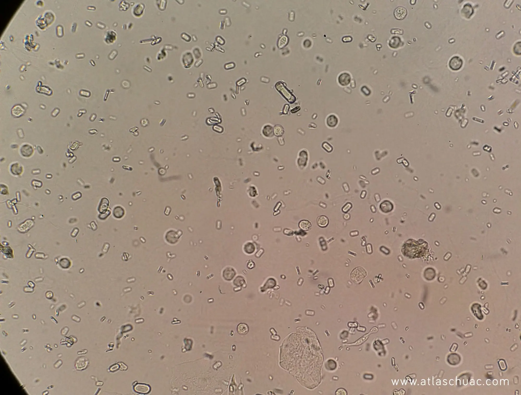 cristales de acido hipurico en sedimento urinario - Qué significa ácido hipúrico en orina