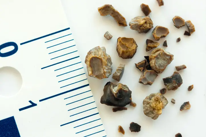 cristales de oxalato de calcio en orina causas - Qué significa tener abundantes cristales de oxalato de calcio