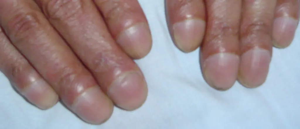 Uñas en vidrio de reloj: ¿Qué son y qué nos indican? - Qué son las uñas en vidrio de reloj y que nos indican uñas en vidrio de reloj - Qué son las uñas en vidrio de reloj y que nos indican